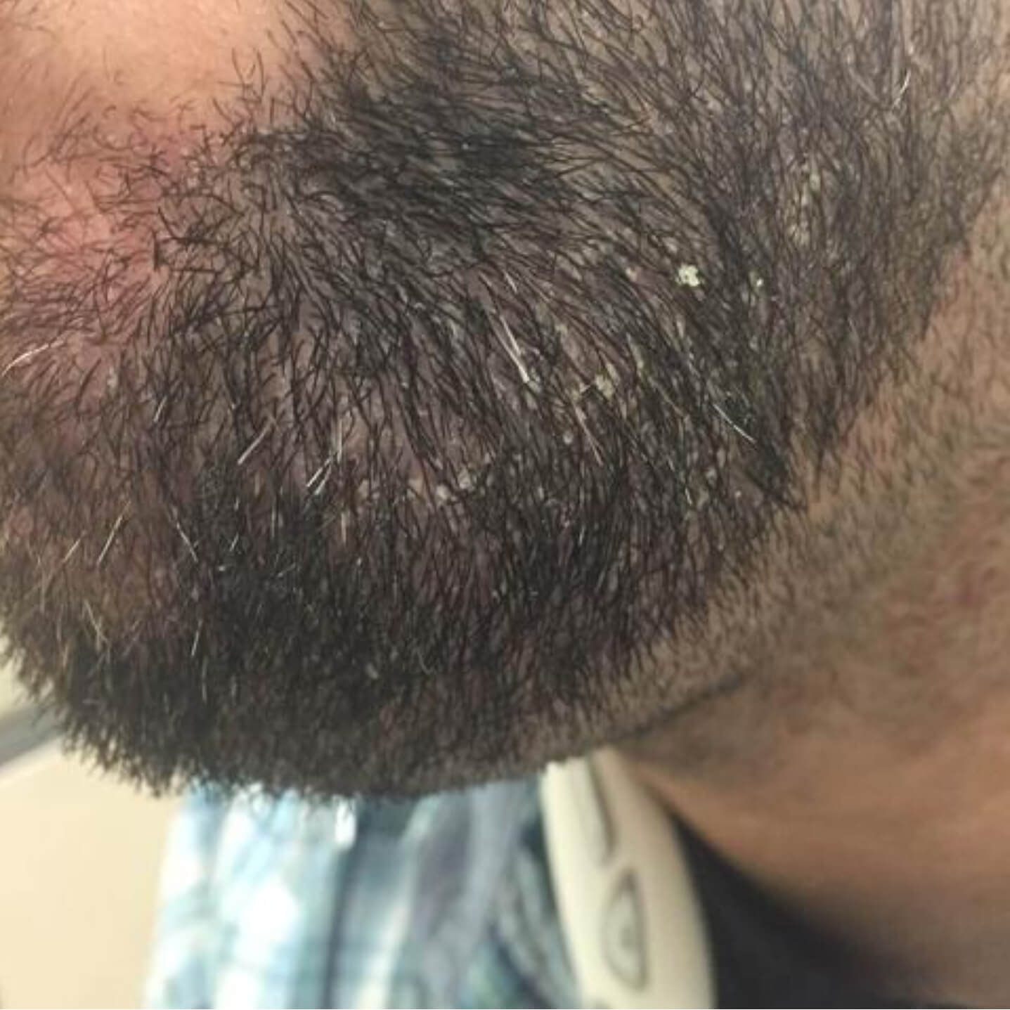 How to Take Care of Seborrheic Dermatitis Under Beards