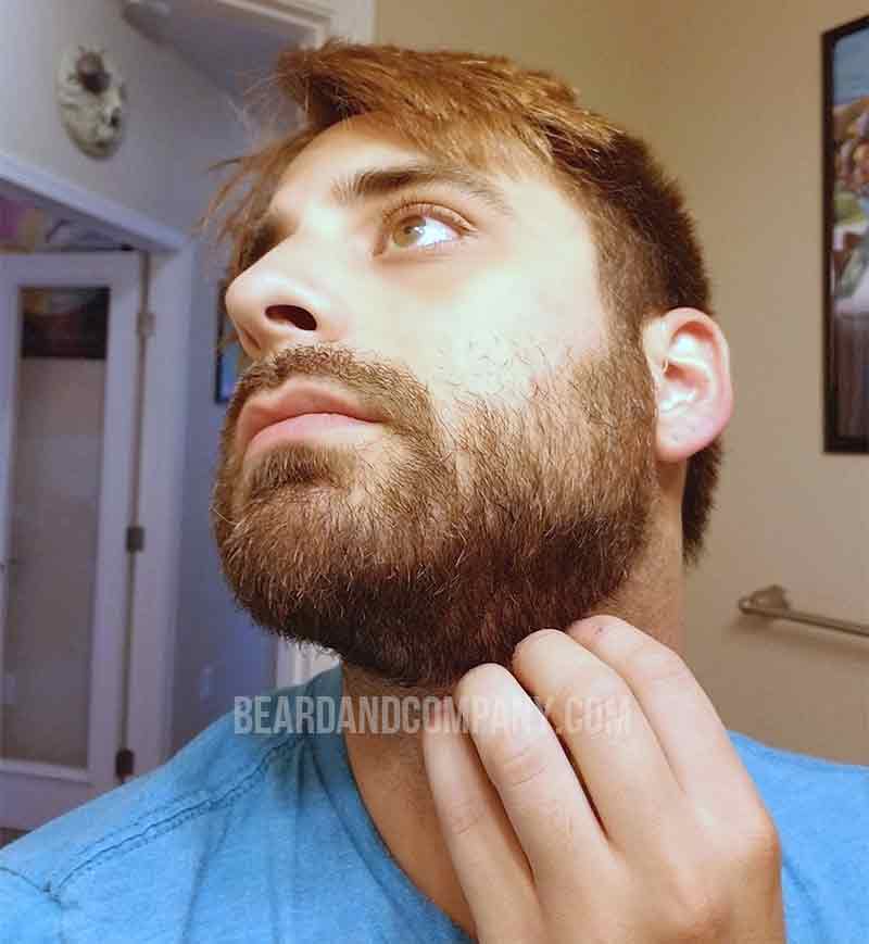 beard itch